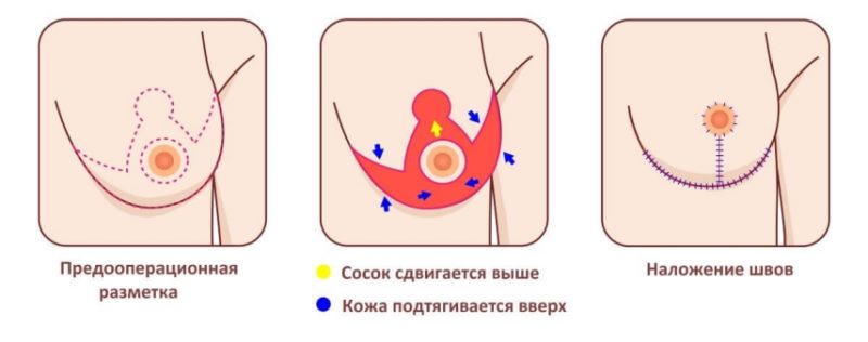 Якорная подтяжка груди в Алматы: цены якорной мастопексии, стоимость